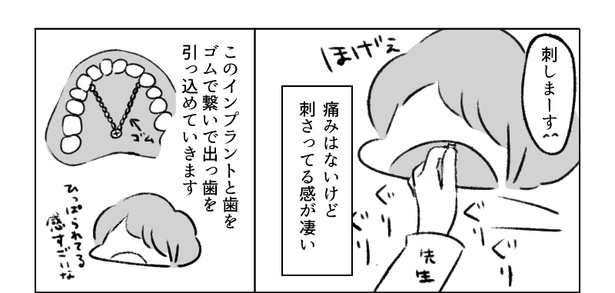 画像37 / 54＞大人になって100万円で歯列矯正したエッセイ漫画に「私も