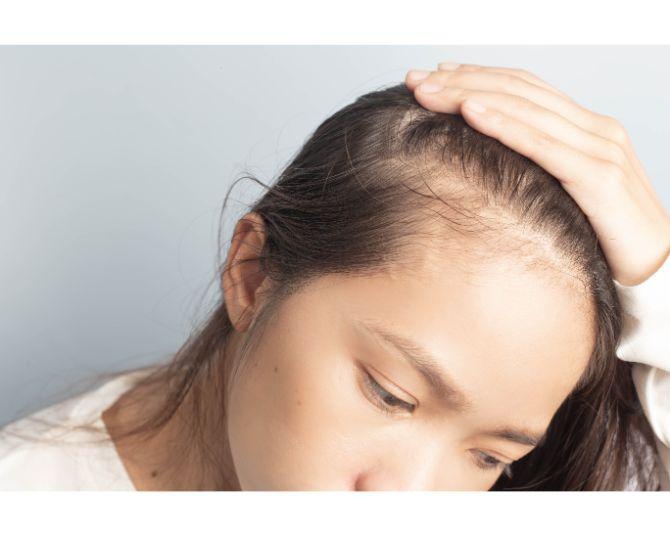 女性特有の薄毛「FAGA」に悩む人が年々増加、今日からできる薄毛の予防対策を紹介！