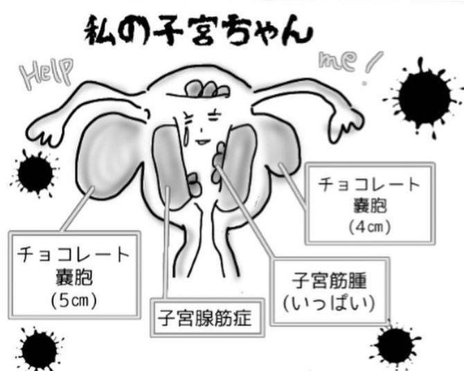 突然の腹痛！検査結果は、チョコレート嚢胞と多発性子宮筋腫に子宮腺筋症のフルコース!?さらに手術はなんと4カ月待ち！【作者に聞く】