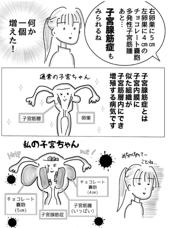 子宮内膜症で入院した時の話4-2
