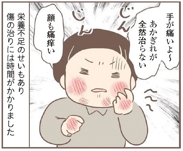 日々、水仕事をさせられていたキヨはあかぎれに悩まされた